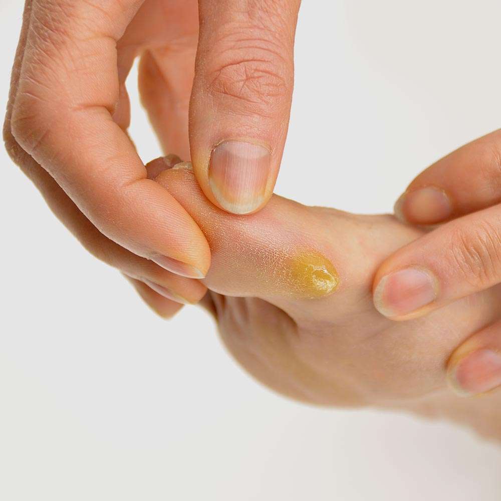 Foot with callus on it