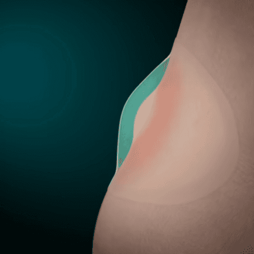 illustration of blister plaster on blister